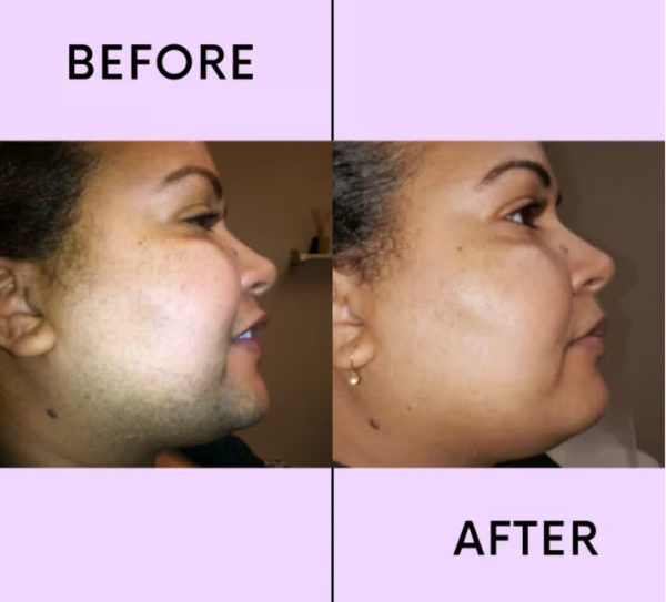 💖LAST DAY 60% OFF-🔥Hair Removal Kit - Image 5