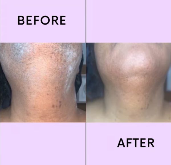 💖LAST DAY 60% OFF-🔥Hair Removal Kit - Image 4